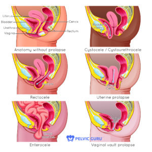 Diagram illustrating the types of pelvic organ prolapse, including rectocele, cystocele, and uterine prolapse, alongside a comparison of normal anatomy without prolapse.