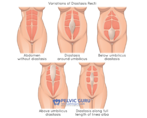 Illustration showing the various ways diastasis recti can present and where it might be located on the abdomen.