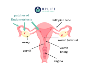 Detailed anatomical diagram of a uterus with endometriosis, showing affected areas and labeled parts.